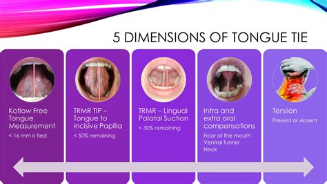 Diagnosing A Posterior Tongue Tie