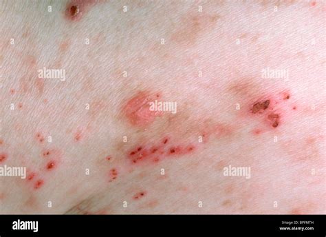 PRURITIC RASH Stock Photo - Alamy