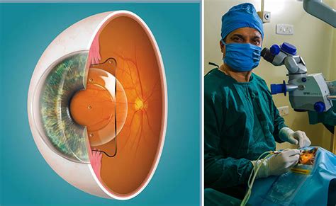 ICL (Implantable Contact Lens) - Prasad Netralaya