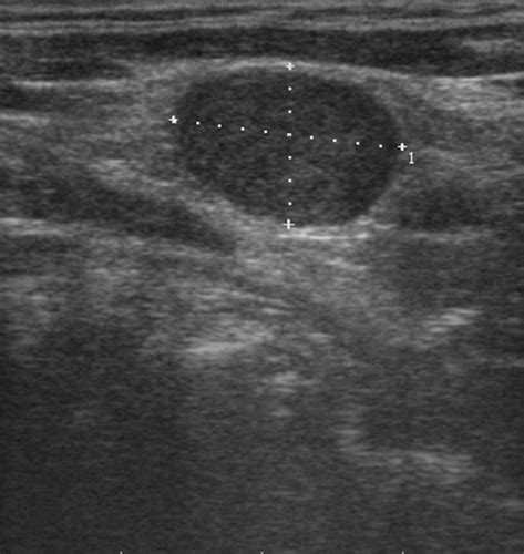 Ultrasonographic Differentiation of Benign From Malignant Neck Lymphadenopathy in Thyroid Cancer ...