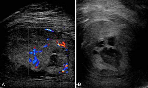 Abscesos testiculares: abordaje quirúrgico. A propósito de 2 casos ...