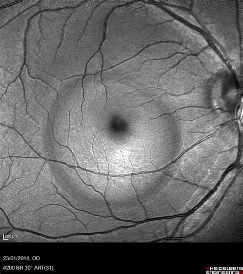 Central Serous Retinopathy (Red Free) - Retina Image Bank