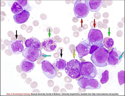 Acute myeloid leukaemia with inv(16)(p131q22) or t(16;16)(p13.1;q22 ...