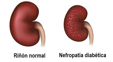 Resultado de imagen para riñon diabetico | Nefropatía diabética, Nefropatía, Diabética