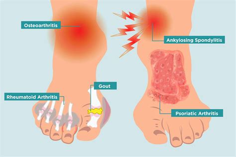 How Arthritis Strikes Your Feet, and 11 Ways to Heal Your Arthritis Foot Pain - CreakyJoints ...