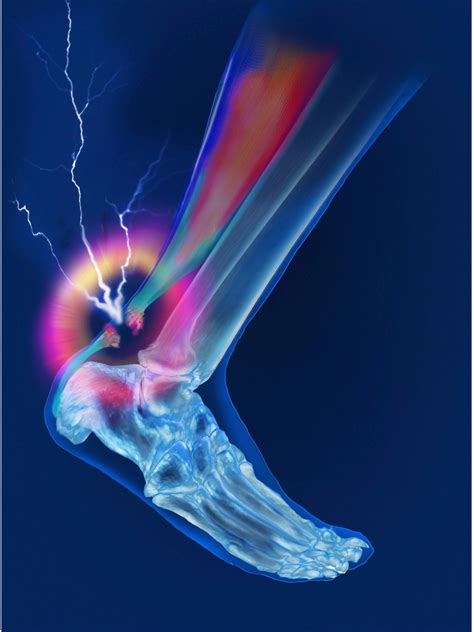 10 Achilles Tendon Injury Facts You Need to Know - KPJohnsonMD