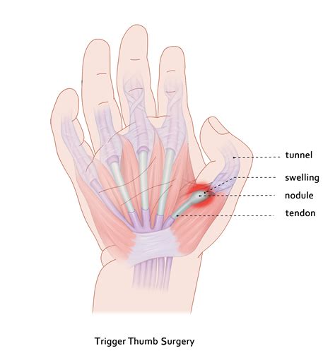 Trigger Thumb | Randwick Plastic Surgery