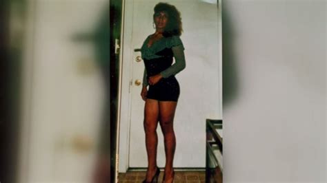 Woman Suffering Complications 30 Years After Botched Buttock Injections – NBC Los Angeles