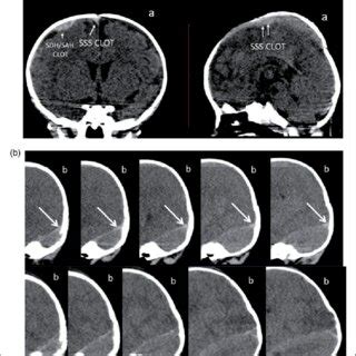 (a) Case 9 coronal and sagittal computed tomography (CT) images showing ...