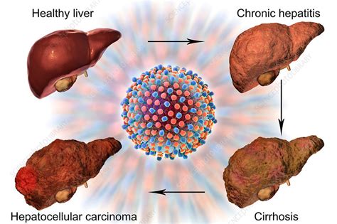 Stages of liver disease in hepatitis C, illustration - Stock Image F019 ...