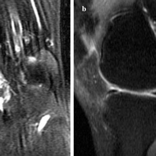 MRI of Right knee T2. (A) Sagittal view, (B) Coronal view. | Download ...