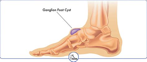 Foot and Ankle Ganglion Cysts Treatment Near Me