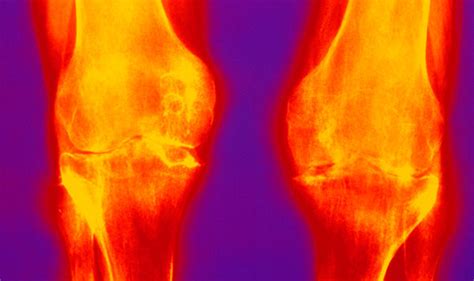 Arthritis symptoms: Are you at risk? Five signs of osteoarthritis in ...