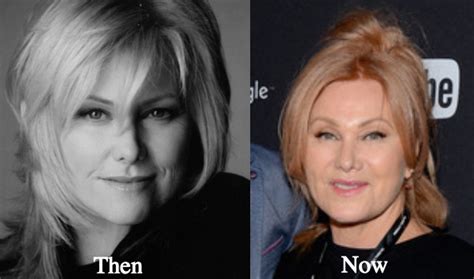 Deborra-Lee Furness Plastic Surgery Before and After Photos