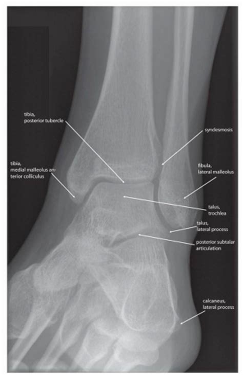 Diagnostic Imaging Techniques of the Foot and Ankle | Musculoskeletal Key