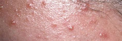 Pityriasis Folliculitis