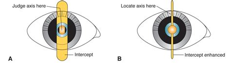 Finding the cylinder axis - American Academy of Ophthalmology