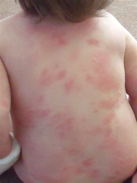 Allergic erythema multiforme reaction to amoxicillin in children and toddlers