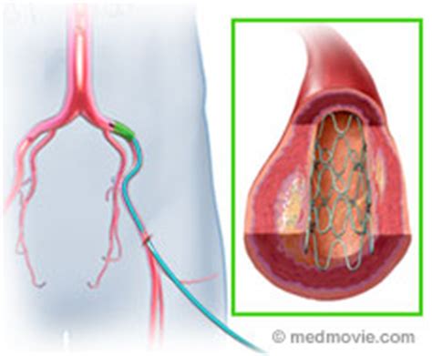 Iliac Artery Stent