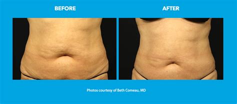 Coolsculpting Before After Stomach - Dr. Beth Comeau MD