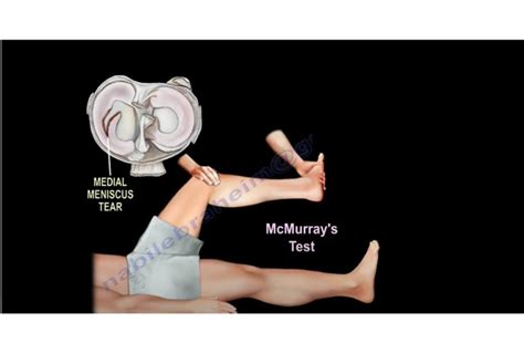 McMurray’s Test for Meniscal Tear — OrthopaedicPrinciples.com