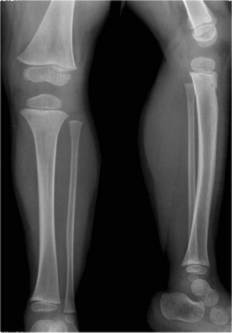 "The Limping Child" - radiology interpretation SAQ's - RCEMLearning India