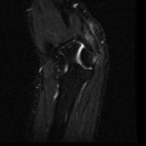 Ulnar nerve entrapment syndrome in cubitus valgus | Radiology Case | Radiopaedia.org