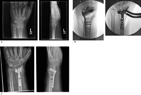52 Distal Radius Osteotomy for Malunion (Volar Approach) | Plastic Surgery Key