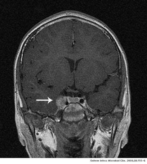 Cavernous Sinus Thrombosis Mrv