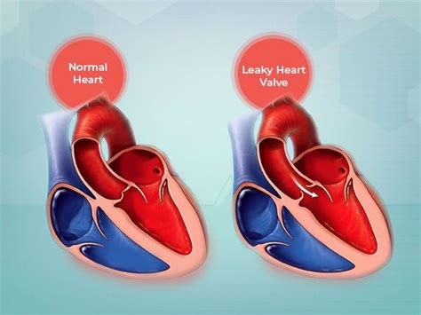 What Is Leaky Heart Valve Its Symptoms Causes And Treatment | Images and Photos finder