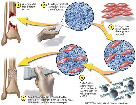 Can Broken Bones Heal Themselves? Microbubbles, Sound And Gene Therapy ...