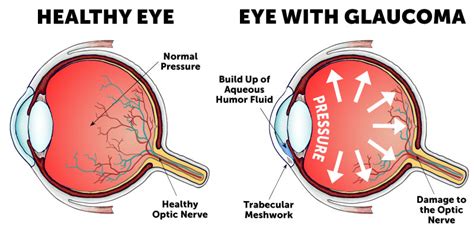 Types of Glaucoma | Wolfe Eye Clinic | Glaucoma Specialists