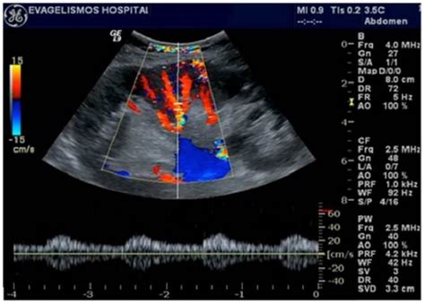 Renal Artery Doppler Ultrasound