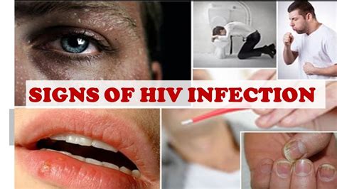 5 Common HIV Symptoms in Men – Ladies, See How To Know If he’s HIV ...