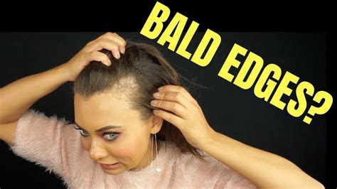 BALD EDGES? WEIRD HAIRLINE? HOW TO HIDE BALD SPOTS OR WEIRD HAIRLINES ...