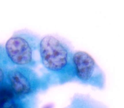 Atypical Urothelial Cells in Urine Symptoms, Causes, Treatment