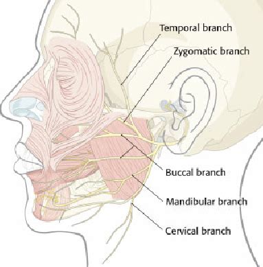 Extratemporal facial nerve branches (temporal, zygomatic, buccal ...