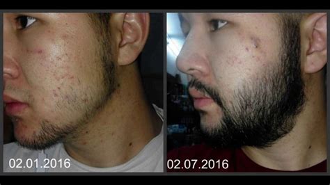 Minoxidil Beard Growth: Real Before and After Photos