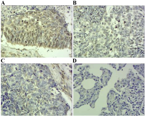 Immunohistochemical staining of squamous cell carcinoma tissue sections ...