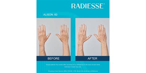 Radiesse Treatment Gallery | Chicago Skin Clinic | Patient Results