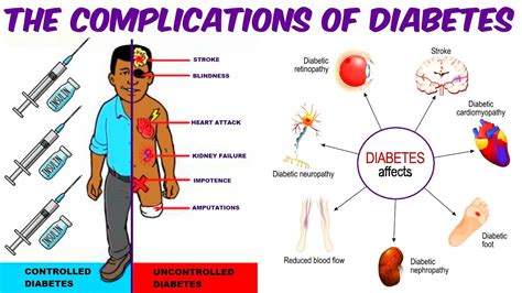 The Complications Of Diabetes - YouTube