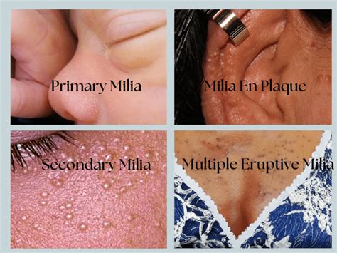 Milia: 8 Factors, Causes, And Helpful Treatment Tips