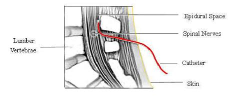 A typical epidural injection procedure | Download Scientific Diagram