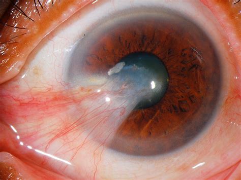 Eye pterygium- Should I prevent it or treat it? How to prevent it.