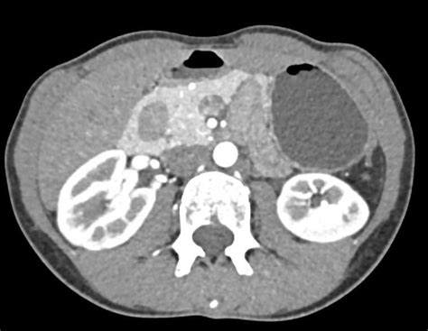 Annular Pancreas / CTisus.com | Pancreas, Case study, Case