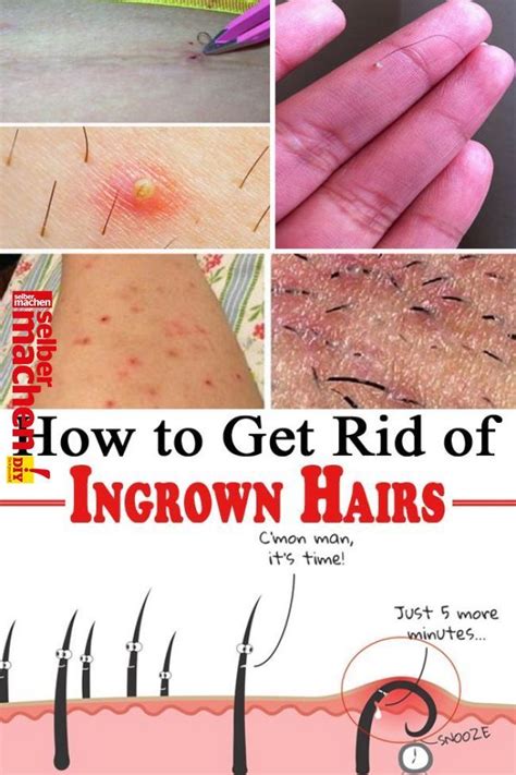 Skin Care Advice That Can Really Help You | Ingrown hair, Treat ingrown hair