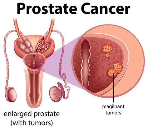 Prostate Cancer - Broward Urology Center