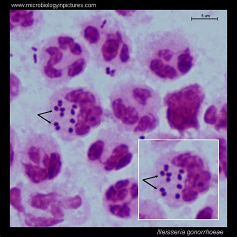 Neisseria gonorrhoeae. Gram stain and cell morphology. Neisseria ...