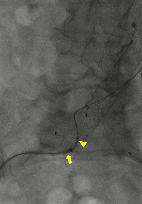 Figure 1 from Iliac Limb Perigraft Access with Robotic Catheter ...