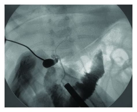 Cholangiography: passage of the contrast agent into the intrahepatic... | Download Scientific ...